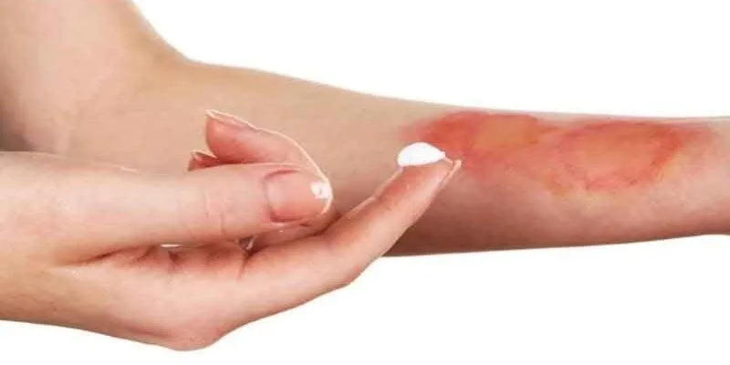 Mơ thấy bị bỏng