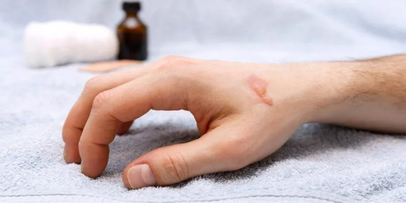 Những tình huống đằng sau giấc mơ bị phỏng